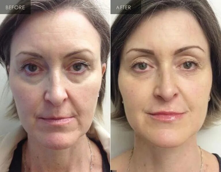 можно ли филлеры под глаза