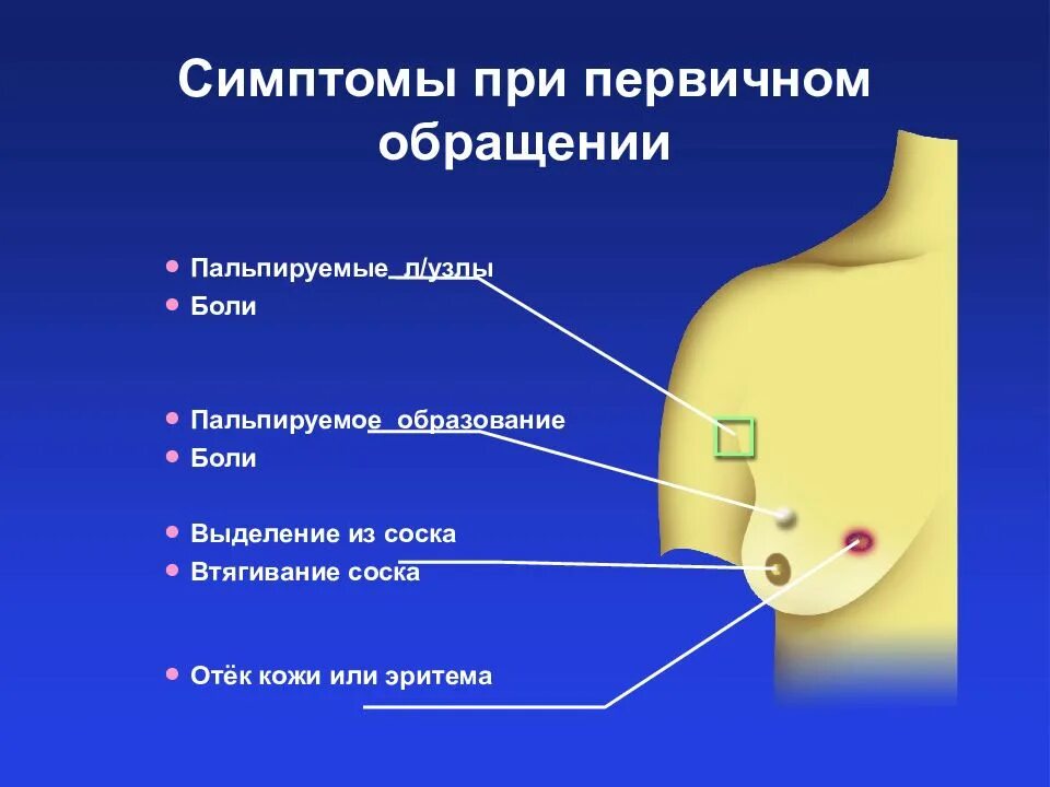 Шишка в грудной железе у женщин