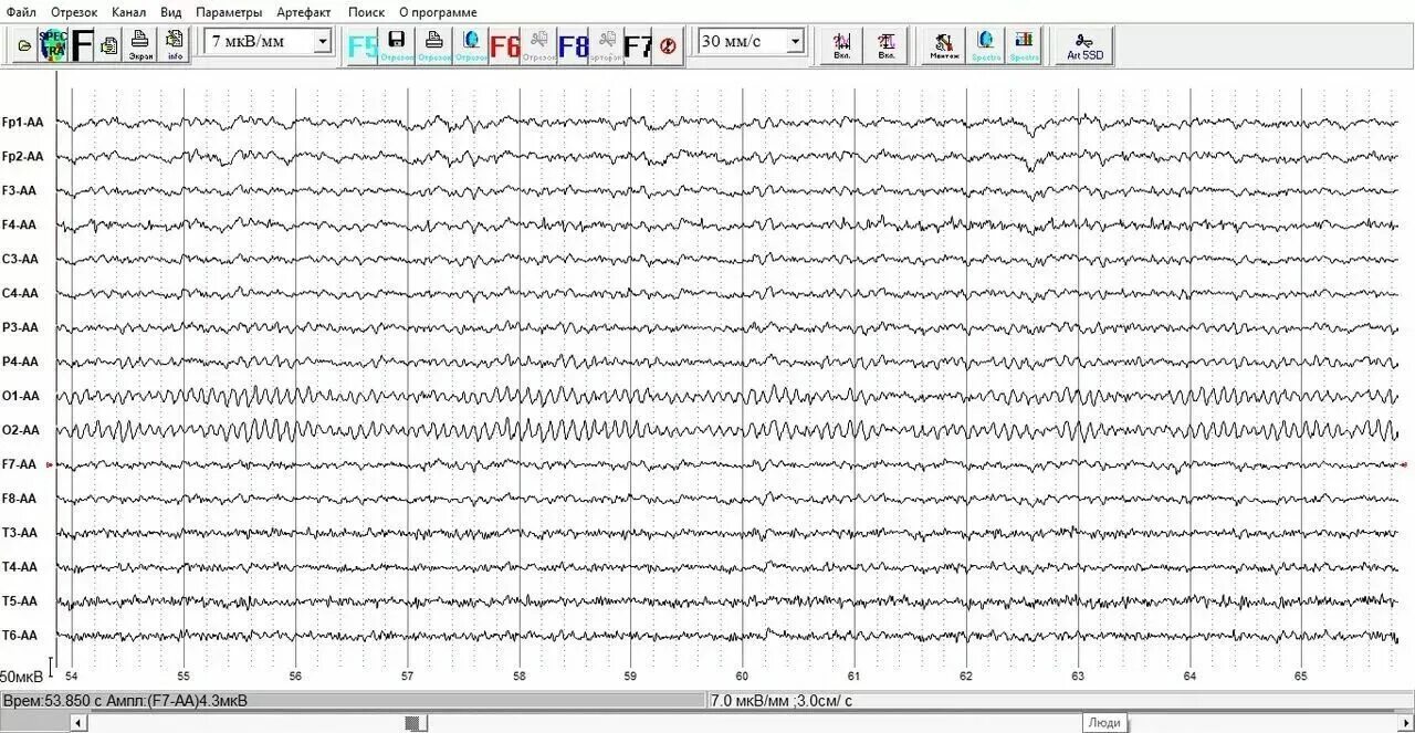 Энцефалограмма. ЭЭГ. Спектральный анализ ЭЭГ. Экран ЭЭГ мониторинга. Ээг красноярск