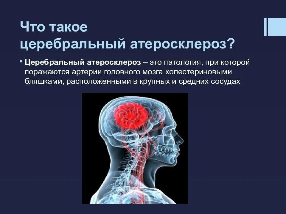 Атеросклероз церебральных сосудов симптомы. Атеросклероз артерий головного мозга. Атеросклеротическое поражение сосудов головного мозга. Атеросклеротические поражения артерий головного мозга. Лечение церебрального атеросклероза сосудов головного