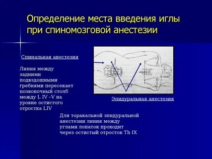 Вкол иглы