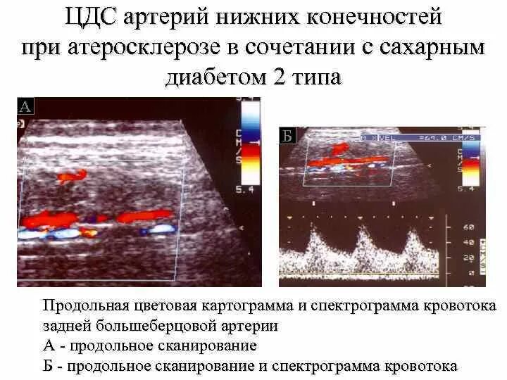 Ультразвуковая дуплексная сканирования нижних конечностей. Ультразвуковая допплерография артерий нижних конечностей. Ультразвуковое цветное дуплексное сканирование тромбоз. Дуплексное сканирование артерий нижних конечностей заключение.