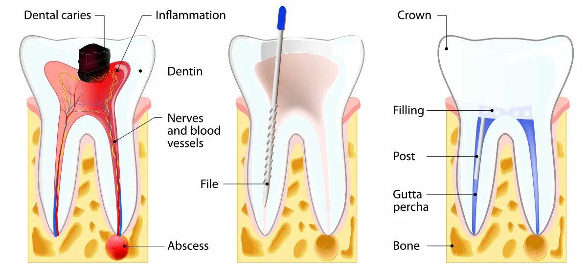 Root canal. 4 Канальный пульпит зуба. Этапы кариеса пульпита.
