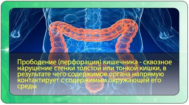 Перфорация кишки с перитонитом. Перфорация тонкого кишечника. Прободение (перфорация) кишечника. Перфорация кишечника симптомы. Что такое перфорация кишечника