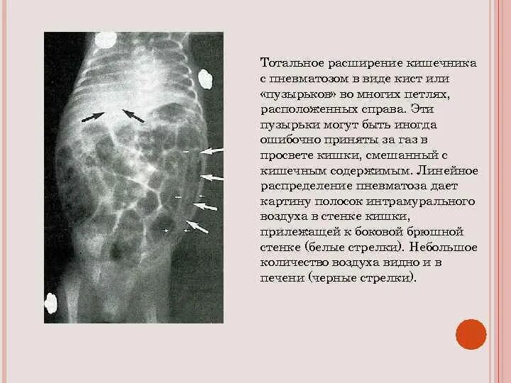 Пневматоз ободочной кишки рентген. Пневматоз тонкого кишечника. Выраженный пневматоз кишечника. Расширение петель кишечника