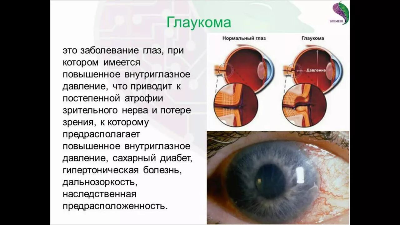 Глазное давление при катаракте. Патологии зрительного нерва глаукома. Глаукома глаза симптомы. Глаза больных глаукомой.