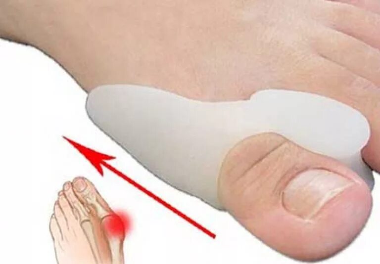 Болит большой палец на ноге чем лечить. Подушечка большого пальца на ноге. Кость возле большого пальца. Болит большой палец на ноге.