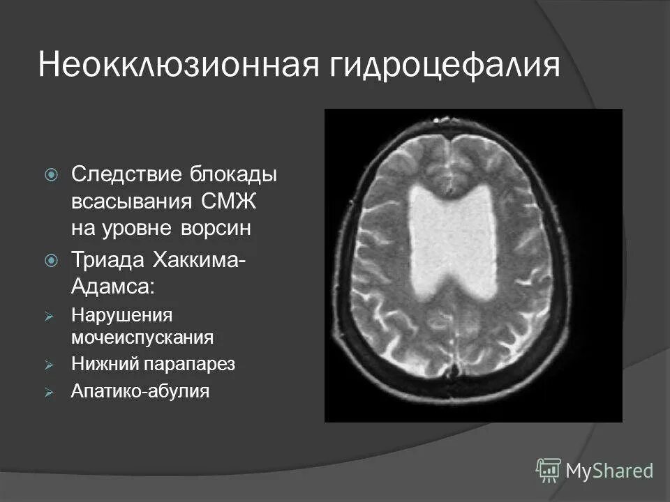 Выражено умеренно гидроцефалия мозга. Гидроцефалия головного мозга на кт. Внутренняя гидроцефалия на кт. Нормотензивная гидроцефалия головного мозга мрт. Мрт головного мозга внутренняя гидроцефалия.