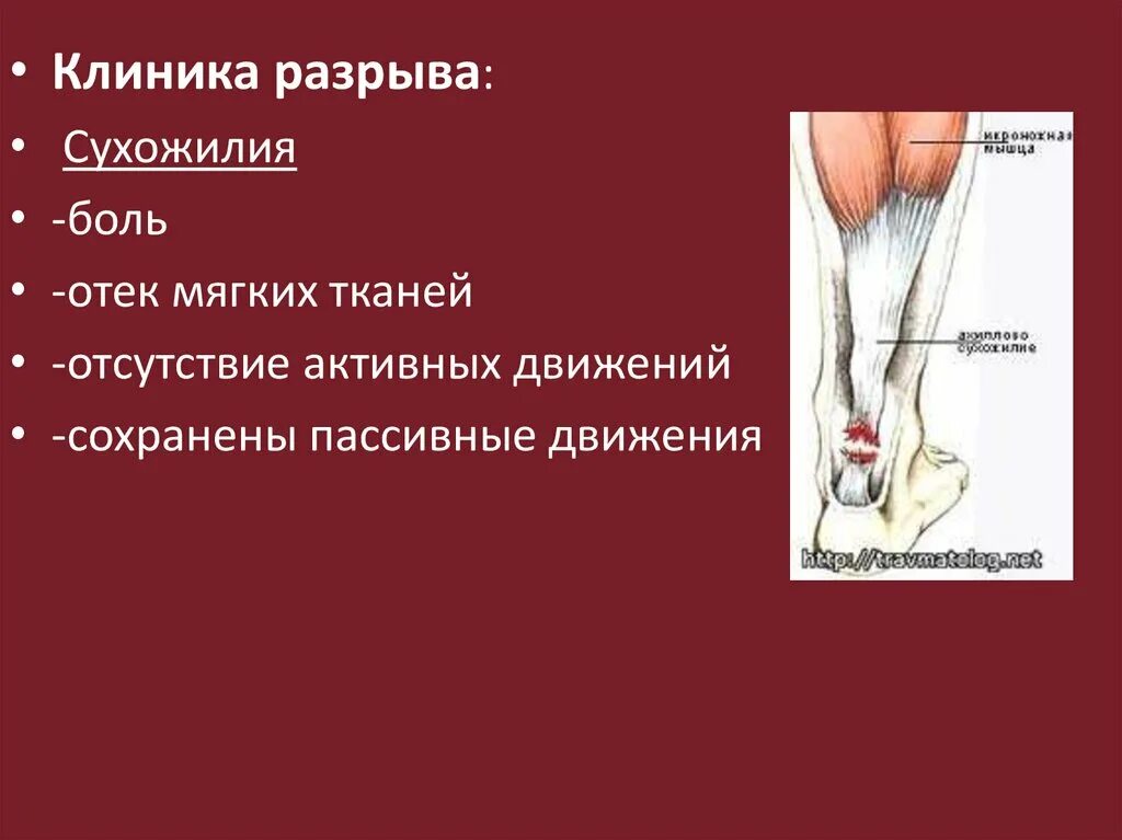 Клиника повреждения сухожилия. Классификация разрывов сухожилий. Клиническим симптомом разрыва сухожилия является.