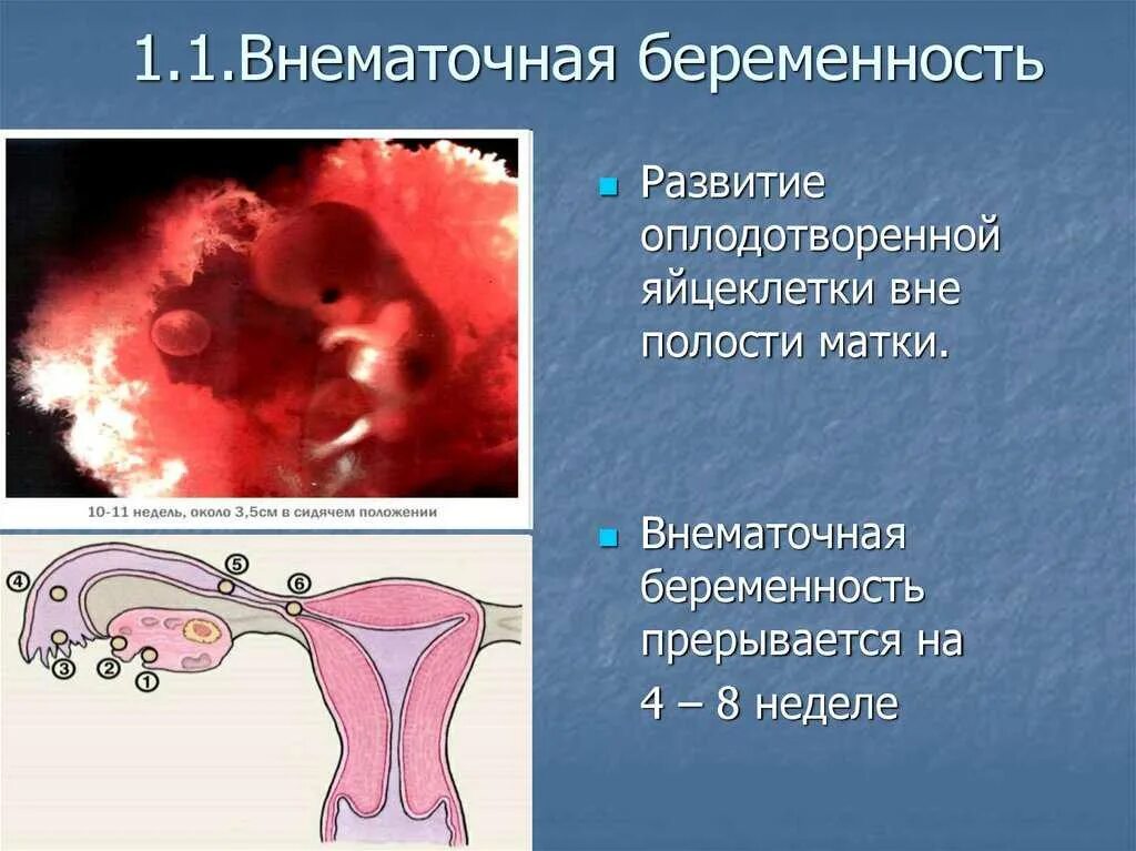 Из за чего может быть внематочная беременность. Внематочная беременность зародыш. внематочная (эктопическая) беременность. внематочная беременность в маточной трубе. беременность в маточной трубе.