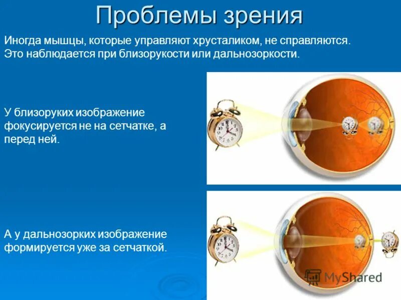 Миопия сетчатки. Дальнозоркость изображение фокусируется. При близорукости изображение фокусируется позади сетчатки. При близорукости лучи света фокусируются за сетчаткой. Перед сетчаткой при дальнозоркости.