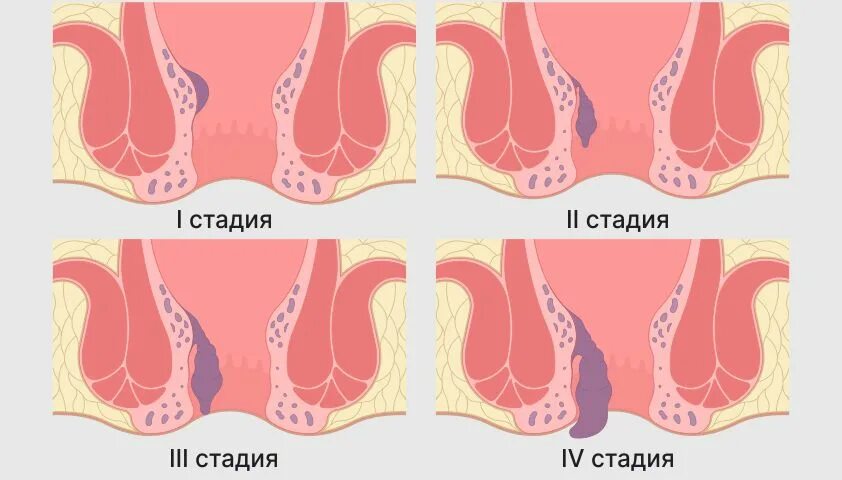 Боли в заднем проходе симптомы. Боли в заднем проходе симптомы