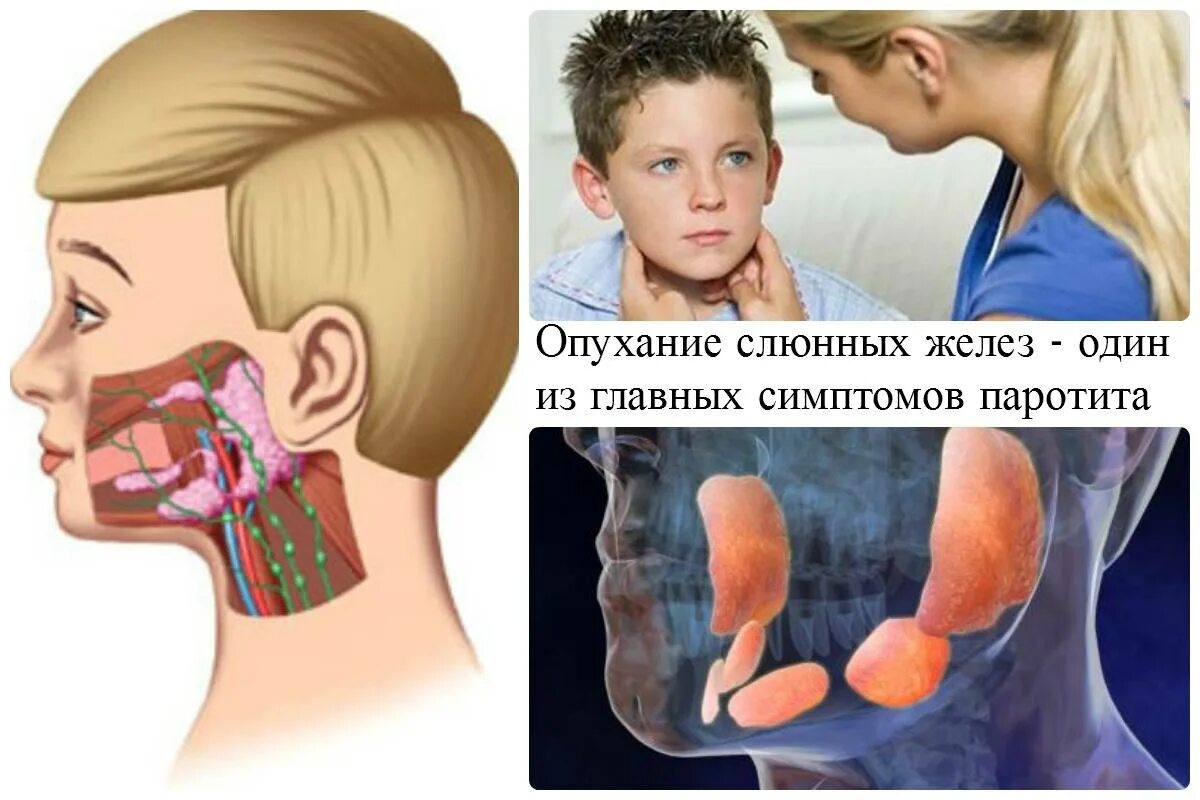 Как лечить свинку у взрослых
