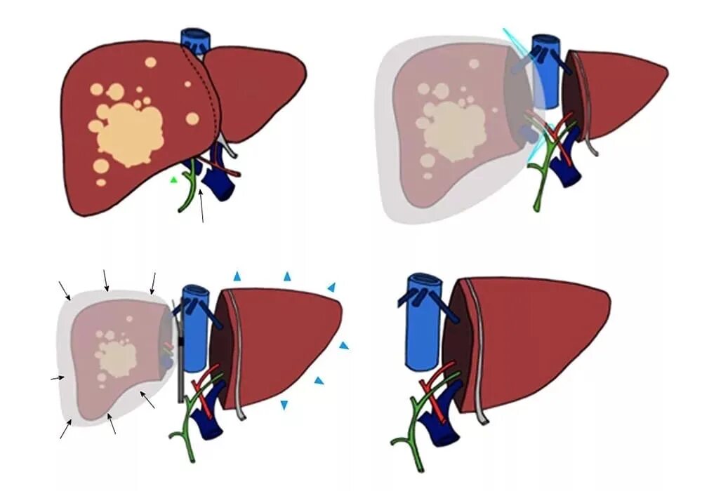 Трансартериальная химиоэмболизация печени. Лобэктомия – резекция доли печени;. Операции при опухолях печени. Типичная резекция печени. Рак печени 3 стадии
