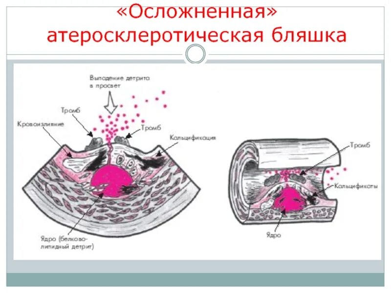 Тканевой детрит это. Микроскопия выпотных жидкостей. Микроскопия кала растительная клетчатка непереваримая. Образование осложненной атеросклеротической бляшки. Детрит атеросклеротической бляшки.