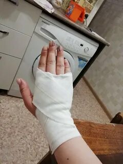 Рука девушки в гипсе