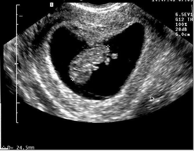 Акушерские и эмбриональные недели. УЗИ на 7-8 акушерской неделе беременности. УЗИ на 9 акушерской неделе беременности. Фото УЗИ на 9 неделе беременности акушерской. 8 Недель беременности фото плода на УЗИ.