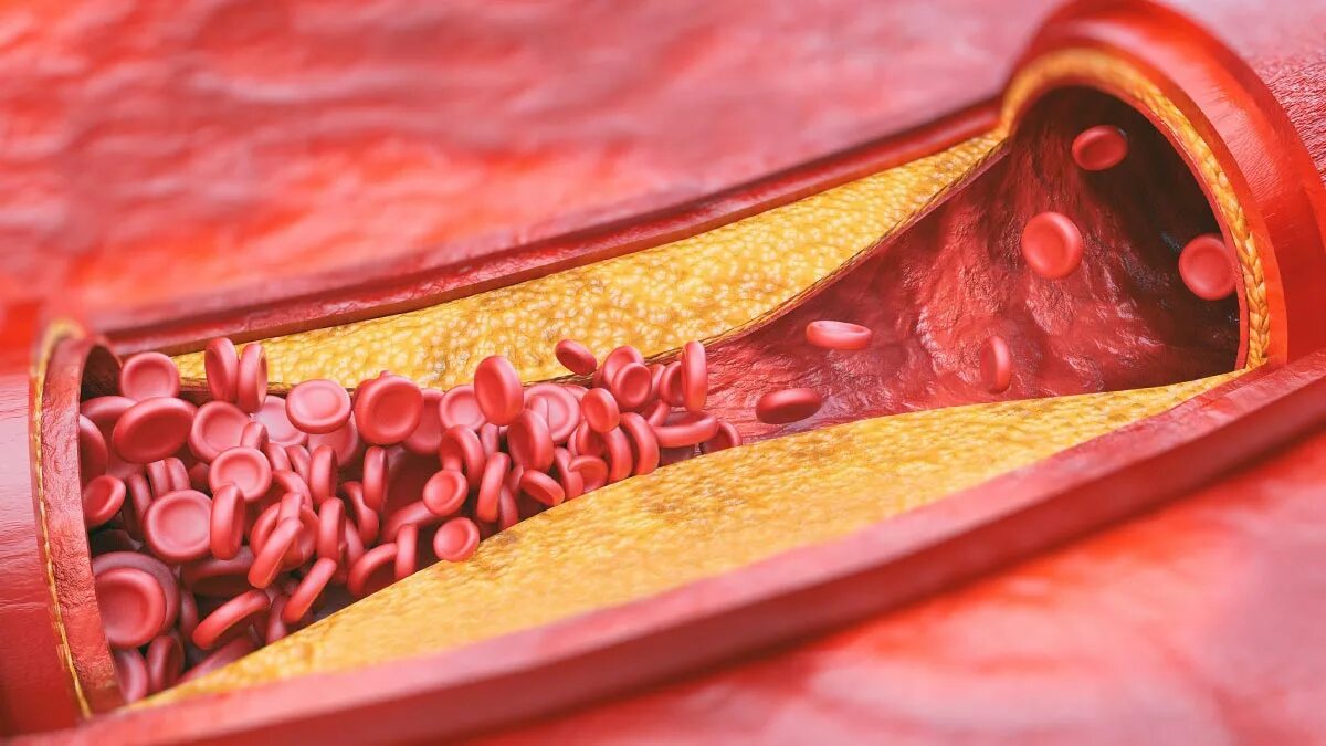 Атеросклероз (закупорка кровеносных сосудов). Тромбоз и эмболия и атеросклероз. Атеросклеротические бляшки в сосудах. Жировые бляшки в сосудах. Хроническое заболевание сосудов