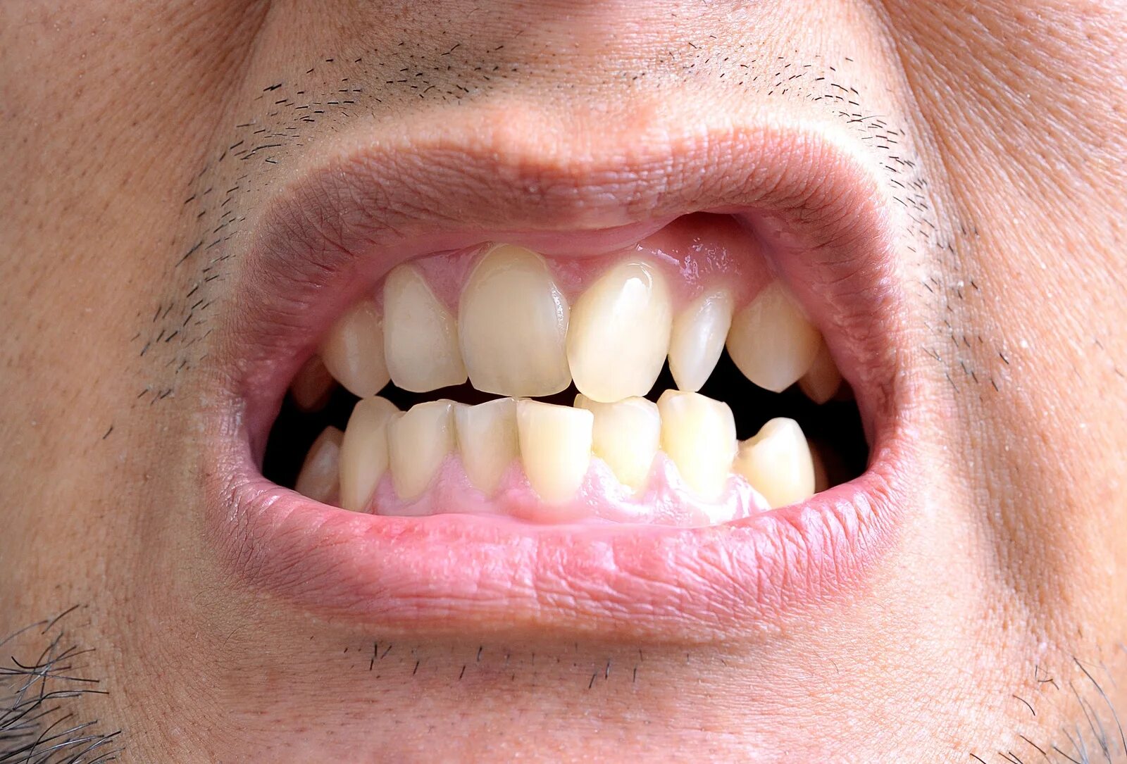 Скученность зубов прикус. Почему сильно зуб