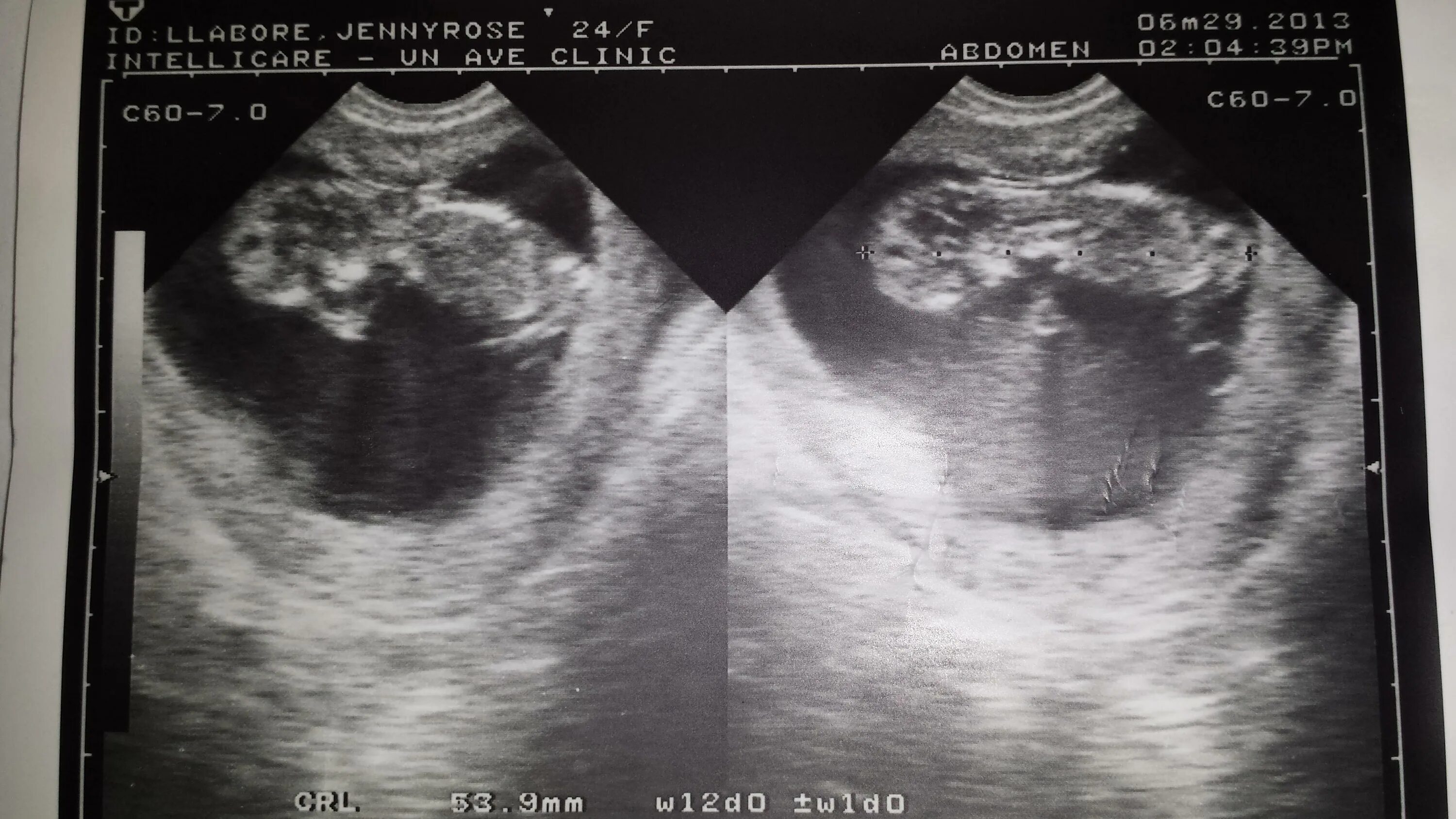 УЗИ беременности двайня 15 недель. УЗИ 11 недель беременности двойня. УЗИ двойняшек на 20 неделе беременности. УЗИ двойни на 14 неделе беременности. 15 неделя 2023