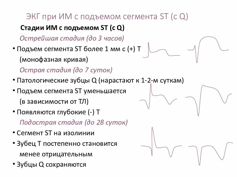 Нестабильная стенокардия карта вызова. ЭКГ при инфаркте миокарда без подъема сегмента St. Инфаркт миокарда с подъемом сегмента ст ЭКГ. Подъем сегмента St на ЭКГ. Элевация сегмента St при инфаркте миокарда.