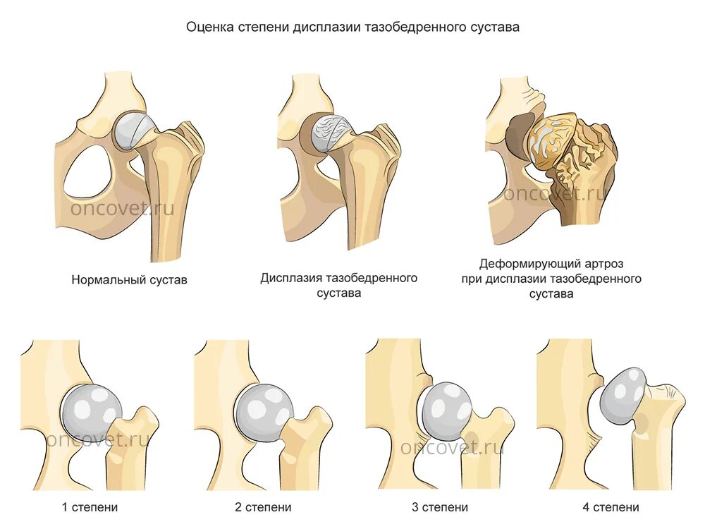 Тазобедренного сустава у детей