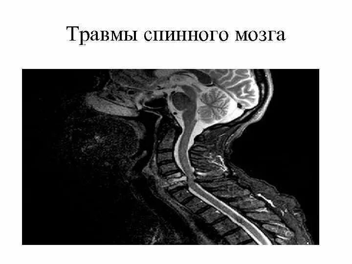 Сотрясение спинного. Классификация разрыва спинного мозга. Травмы головного и спинного мозга.