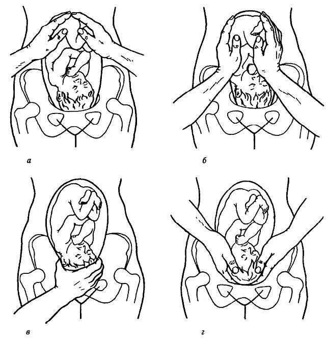 Положение плода акушерское. Приемы наружного акушерского исследования Леопольда Левицкого. Приёмы Леопольда Левицкого в акушерстве. Наружное акушерское исследование приемы Леопольда Левицкого. Третий прием Леопольда-Левицкого.