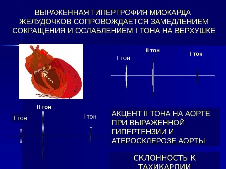 Гипертрофия полостей сердца. Синдром гипертрофии миокарда левого желудочка. гипертрофия левого желудочка классификация.