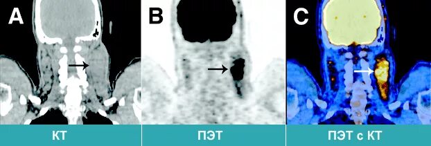 Пэт кт или кт что лучше. Позитронно эмиссионная томография онкология. ПЭТ-кт опухоль позвоночника.