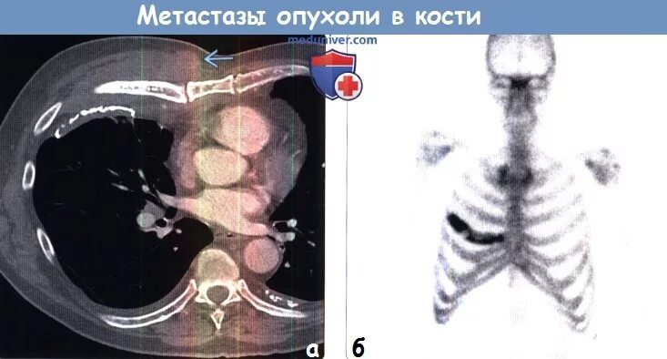 Метастазы в кости при раке предстательной