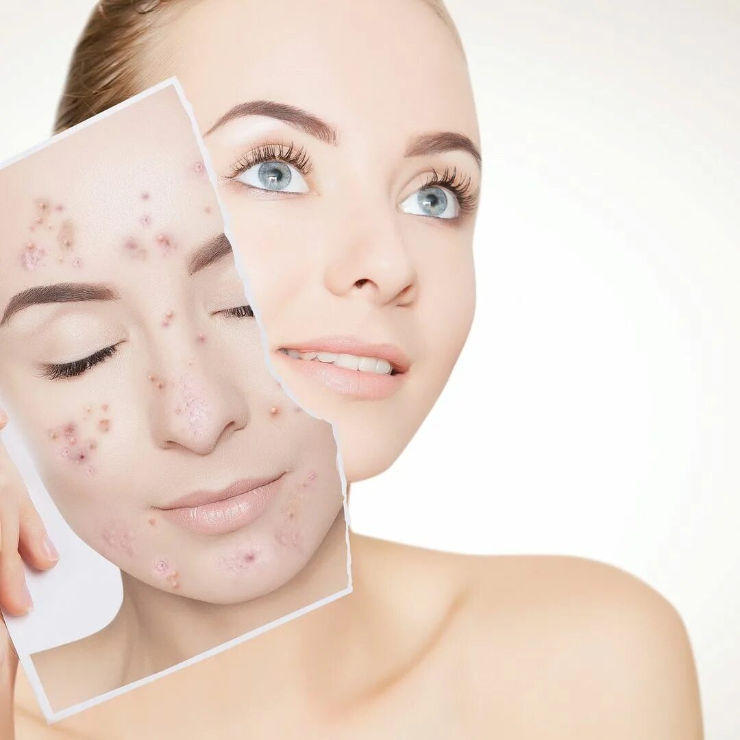 Лечение угревой сыпи акне. Диета при угревой сыпи и черных точек. Диета при угревой сыпи и черных точек. Дерматологи лечение акне отзывы. Угревая сыпь лечение препараты.