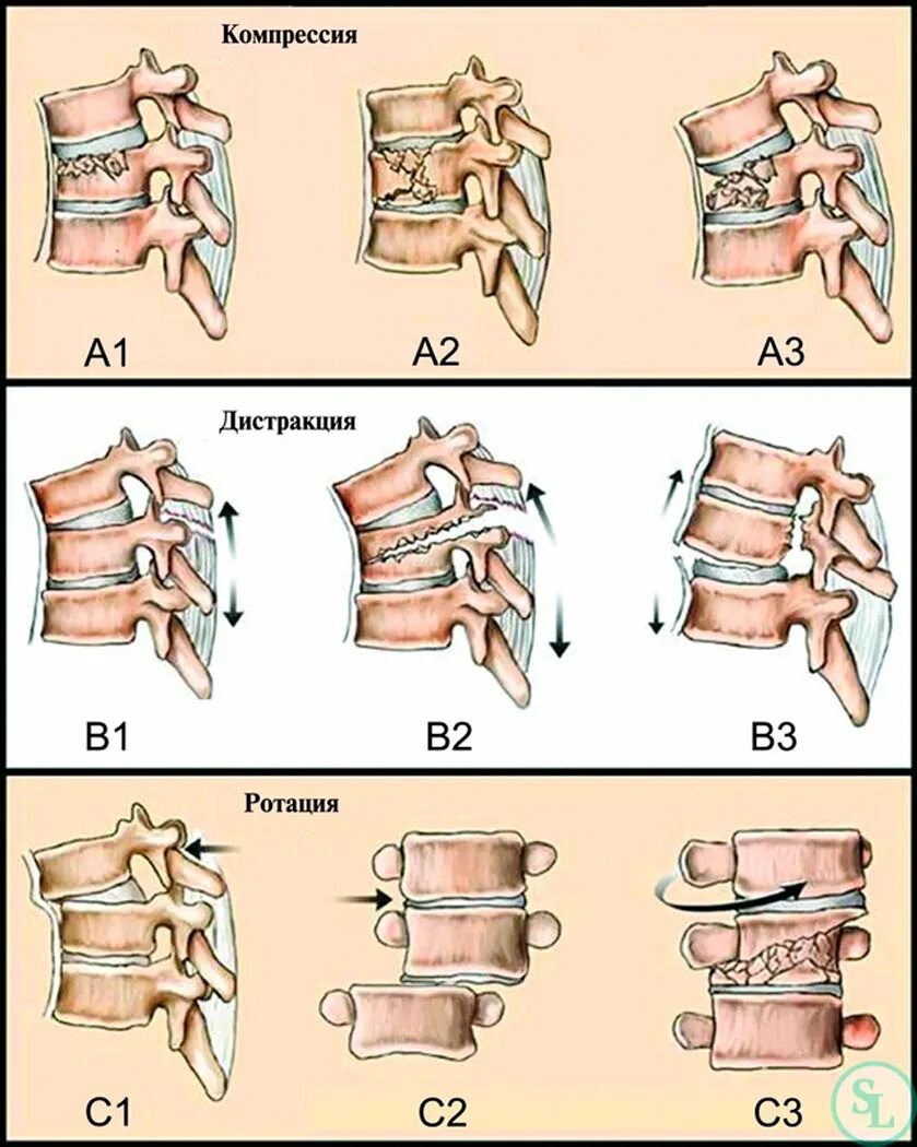 Компрессионный перелом позвоночника поясничного отдела. Дистракционный перелом позвоночника. Патогенез компрессионного перелома позвоночника. Компрессионный перелом позвоночника реабилитация.