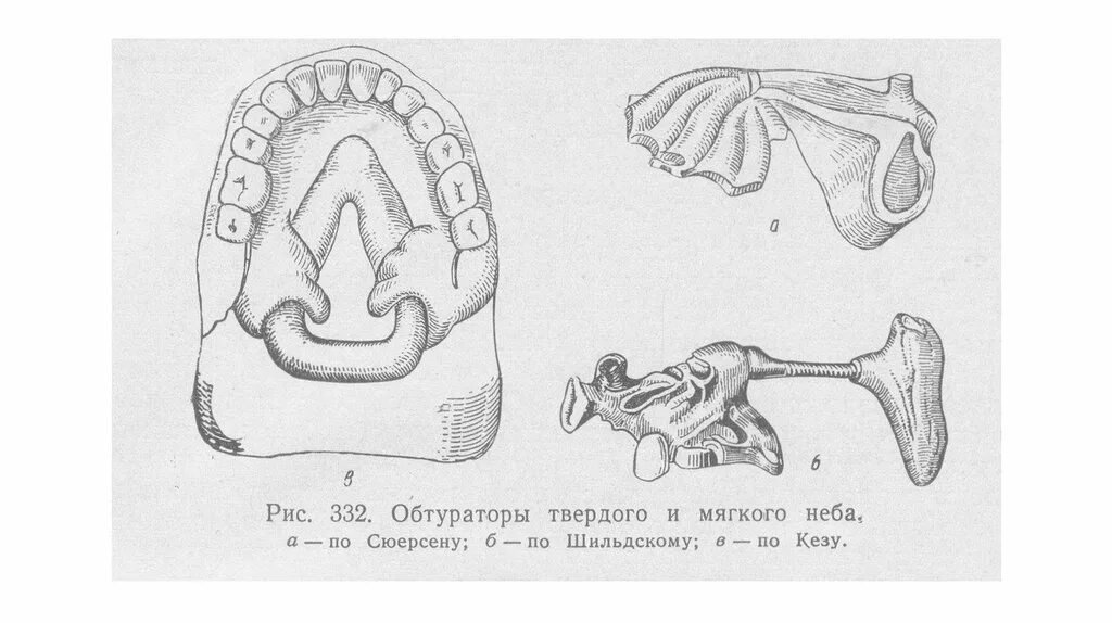 Подвижное соединение челюстей. Плавающий обтуратор Кеза. Обтуратор для новорожденных с расщелиной неба. Обтуратор по Часовской (плавающий). Обтураторы при дефектах твердого и мягкого неба.