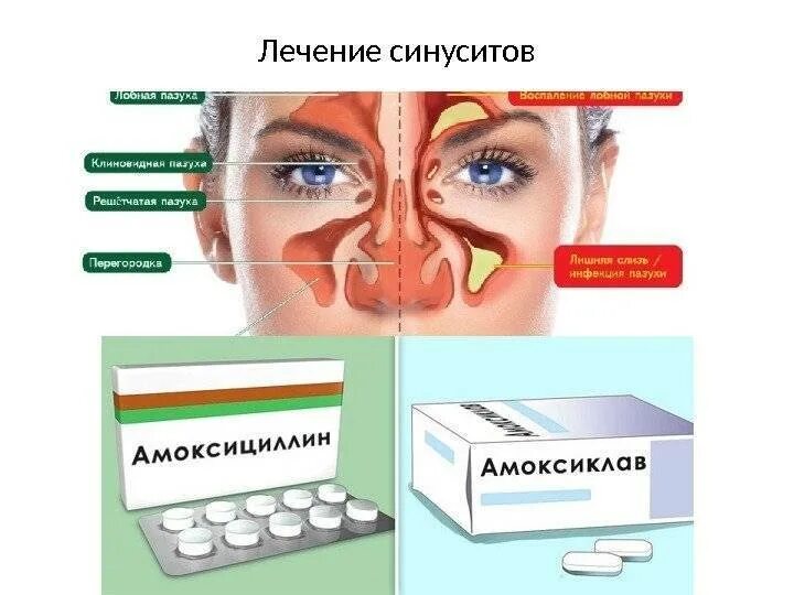 Гайморит симптомы чем лечить. Синусит и гайморит лекарство. Острый и хронический гайморит.