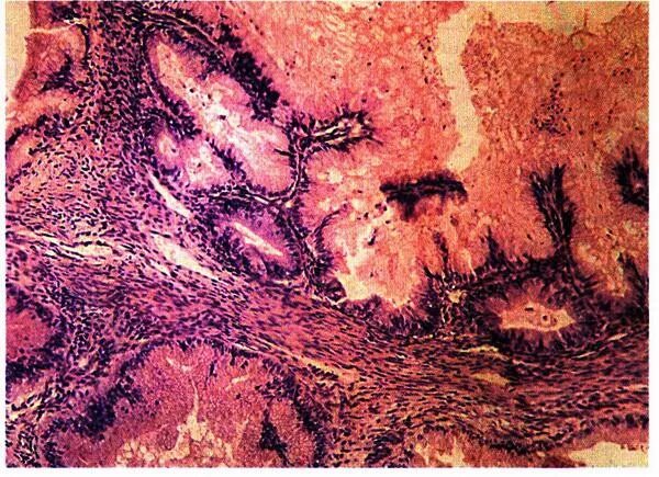 Муцинозная цистаденома гистология. Грубососочковая цистаденома гистология. Серозная папиллярная аденокарцинома. Цистаденома гистология. Серозная пограничная опухоль