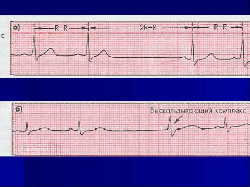 Комплекс блокада. Выскальзывающий ритм из АВ соединения. Выскальзывающие комплексы из АВ соединения. Медленные замещающие выскальзывающие комплексы и ритмы. Выскальзывающие комплексы из АВ соединения на ЭКГ.