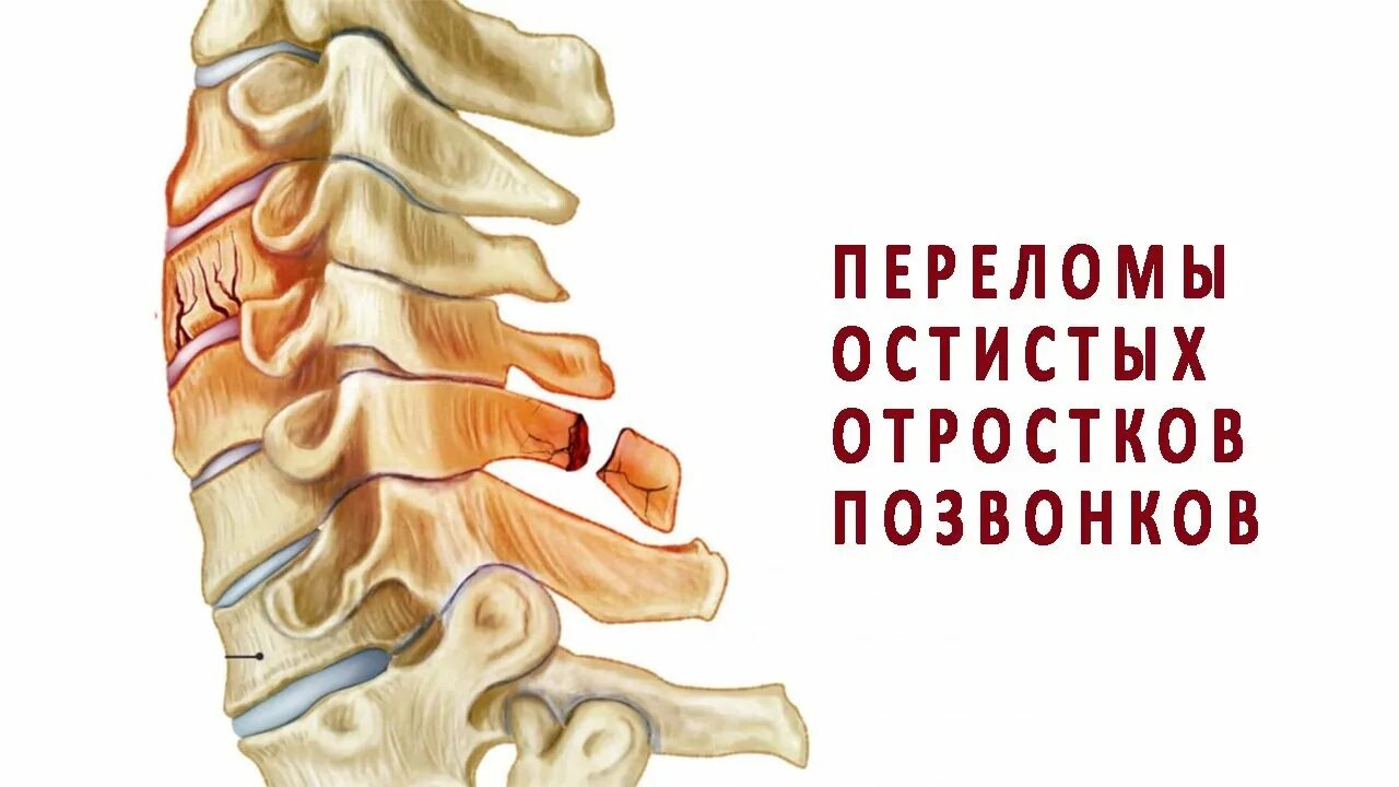 Перелом отростка поясничного позвонка. Перелом остистого отростка l5. перелом остистого отростка l5 рентген. перелом остистого отростка позвонка. перелом остистого отростка 7 шейного позвонка.