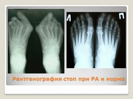Рентген двух стоп