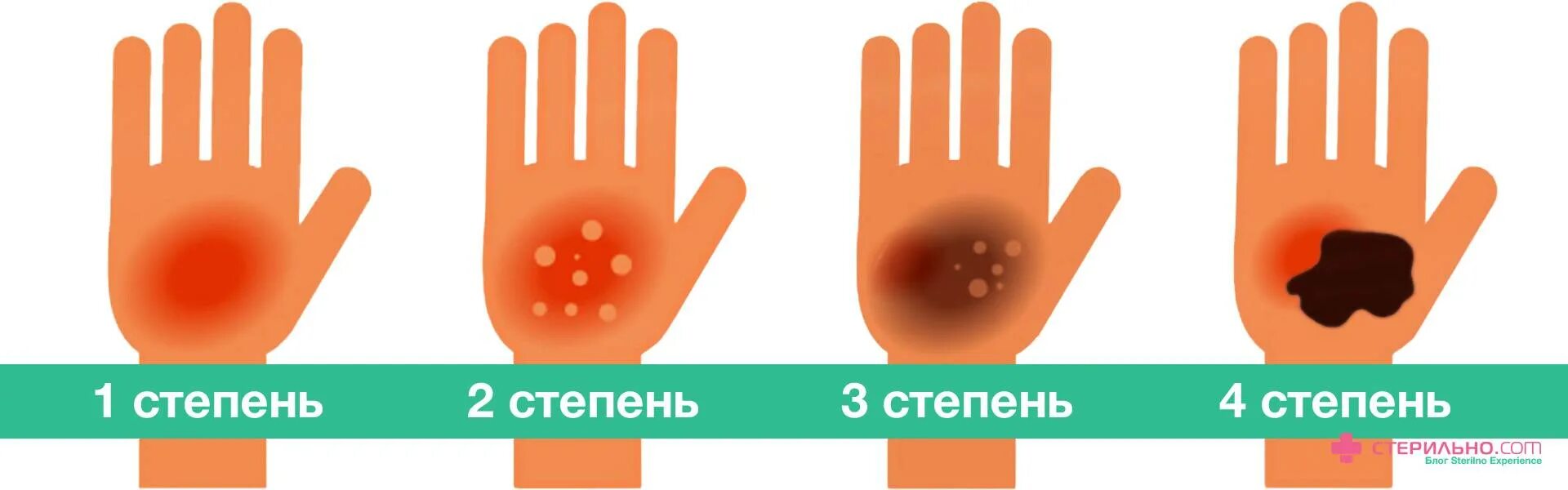 Ожог 2 степени степень тяжести. Ожог 4 степени степень тяжести.