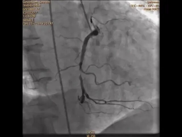 Стеноз ПКА В среднем сегменте. Стеноз прямой