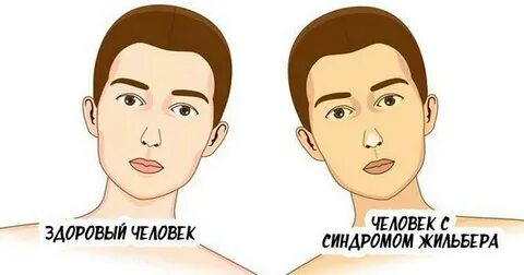 Жильбер болезнь у мужчин