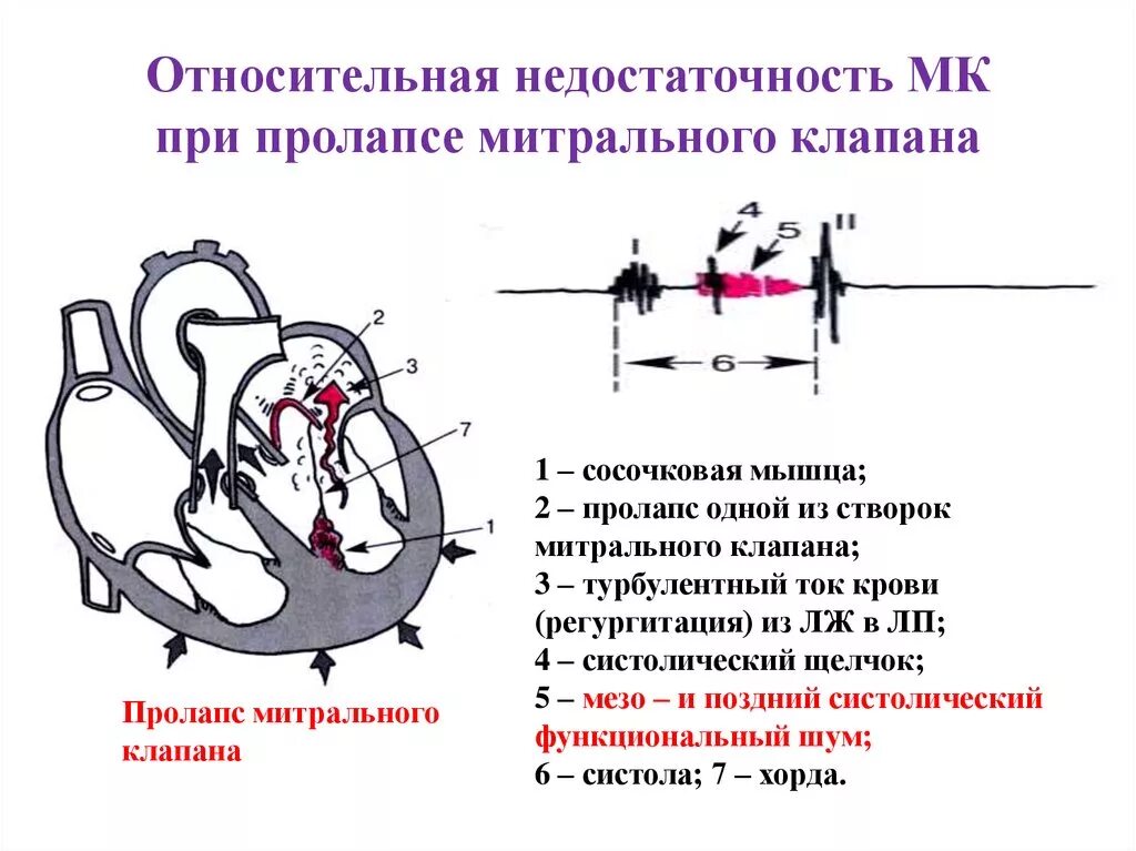 Недостаточность митрального клапана тоны сердца. Недостаточность митрального клапана аускультативно. Недостаточность мк 2 степени. Недостаточность митрального клапана аускультативно. Митральная недостаточность шум.