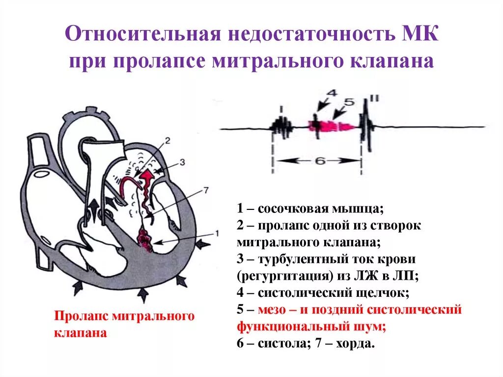 Пролапс митрального клапана 1 степени при аускультации. Относительная недостаточность митрального клапана. Аускультация митральной недостаточности сердца. Недостаточность митрального клапана 2 степени аускультация. Митральная недостаточность гемодинамика