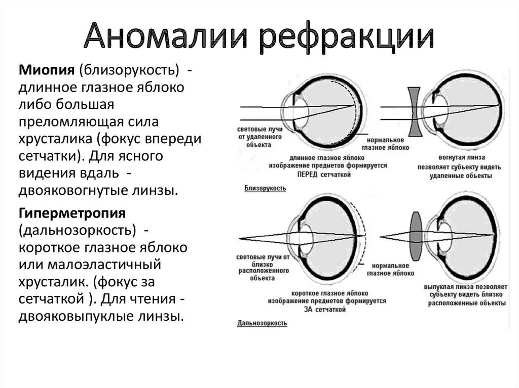 Почему у людей пожилого возраста развивается дальнозоркость. Аккомодация при миопии и гиперметропии. Аномалии рефракции глаза близорукость дальнозоркость таблица. Аномалии рефракции миопия гиперметропия астигматизм. Аномалии рефракции глаза схема.