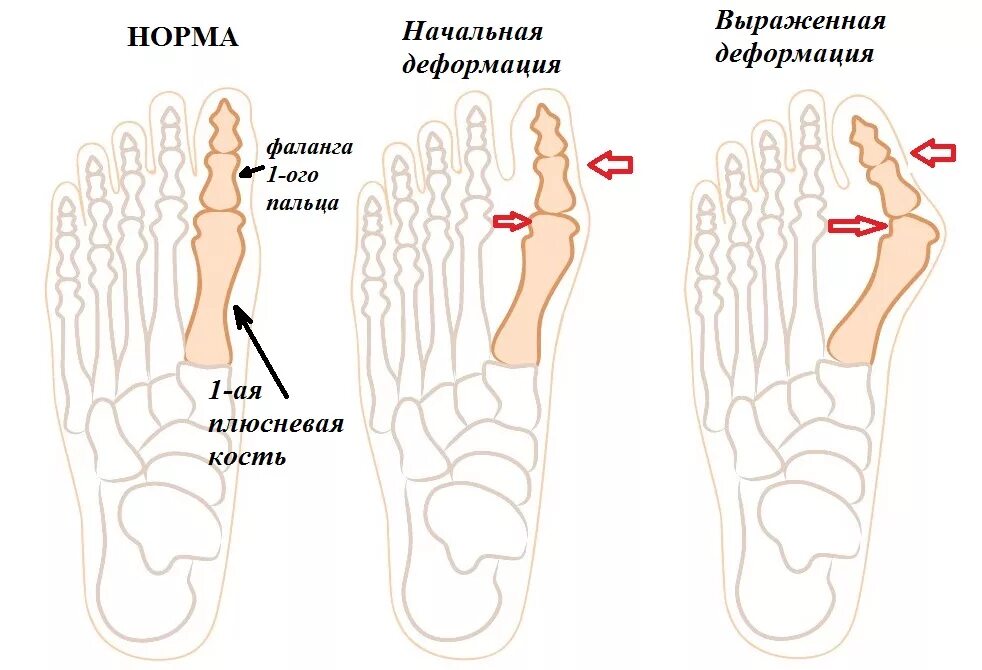 Сильно болят косточки на ногах. Деформация hallux valgus вальгусная. Вальгусная деформация 1 пальца стопы. Хальгус вальгус стоп степени. Вальгусная деформация стопыбрлшого пальца.