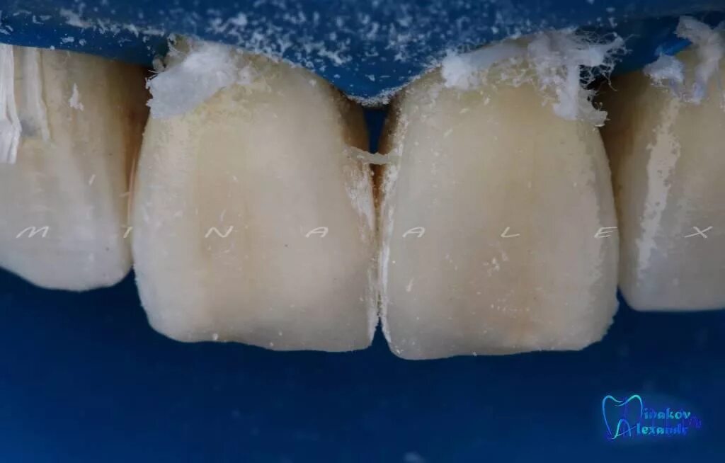 Патология твердых тканей. Некариозные поражения эмали. Некариозные повреждения зубов. Некариозные поражения зубов гипоплазия флюороз. Некариозное поражение твердых тканей зуба.