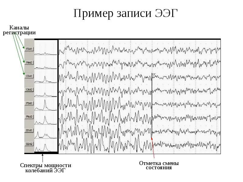 Как выглядит ээг. Нормальная диаграмма ЭЭГ. ЭЭГ волны. Структурная схема ЭЭГ. Лямбда волны на ЭЭГ.