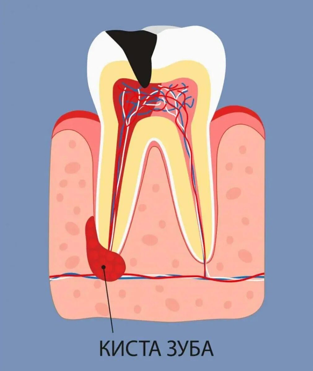 Корневая (радикулярная) киста. Зубы у аиста. Зуб после простуды