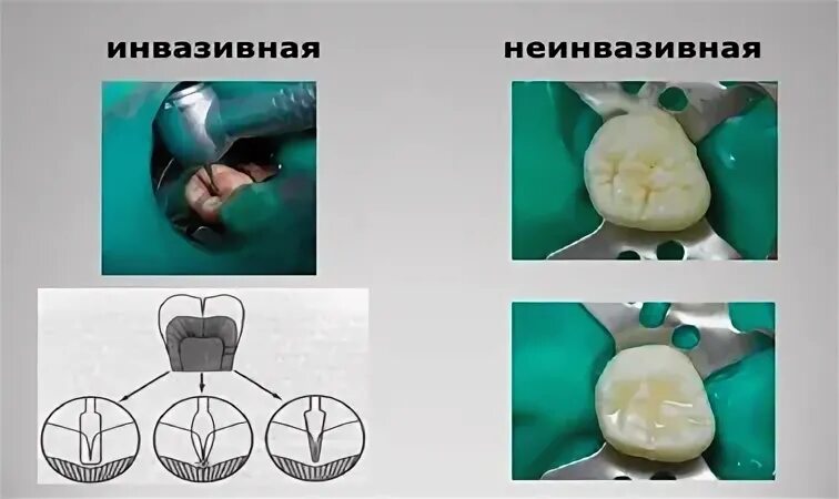 Залить зубы